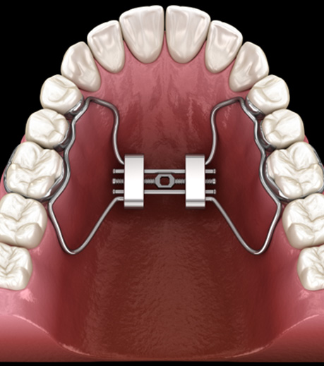 Illustration showing palate expander, viewed from below