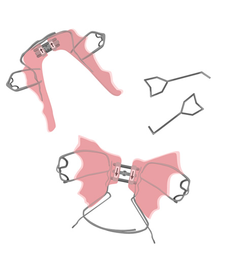 Palate expanders and the keys used to turn them