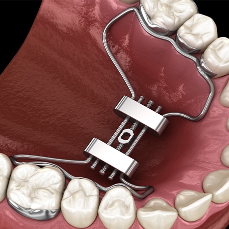 Animated smile with palatal expander in place