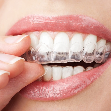 Invisalign Clear Braces for Straight Teeth in Kennesaw - Invisalign  Treatment near Acworth - Clear Aligners