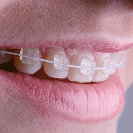 LightForce 3D Printed Ceramic Braces Cumming, Teeth Straightening
