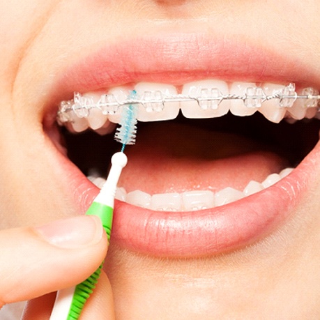 An up-close view of a person using an interdental brush to clean underneath the archwire and between the brackets
