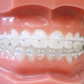 Closeup of smile with Damon Clear2 clear braces