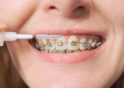 Woman holding an interdental brush close to her braces