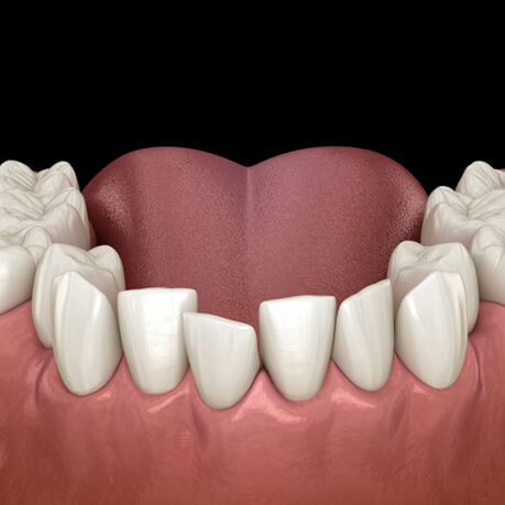 Digital image of crooked teeth in lower dental arch