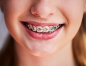 Close up of young woman smiling with braces