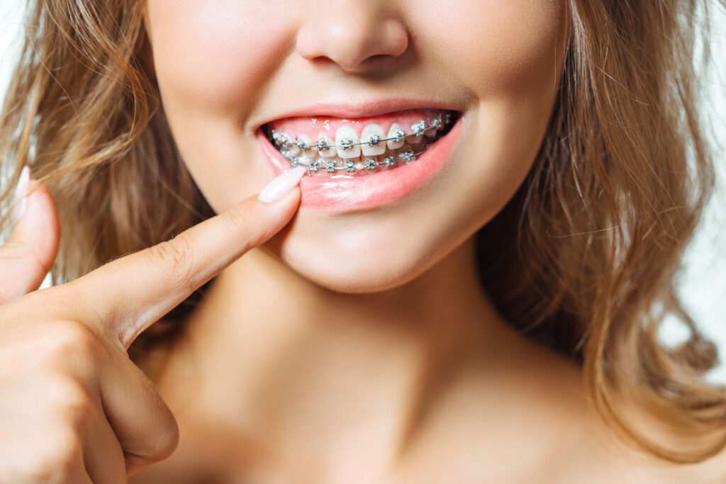 Nose-to-neck view of woman pulling down lip to show braces