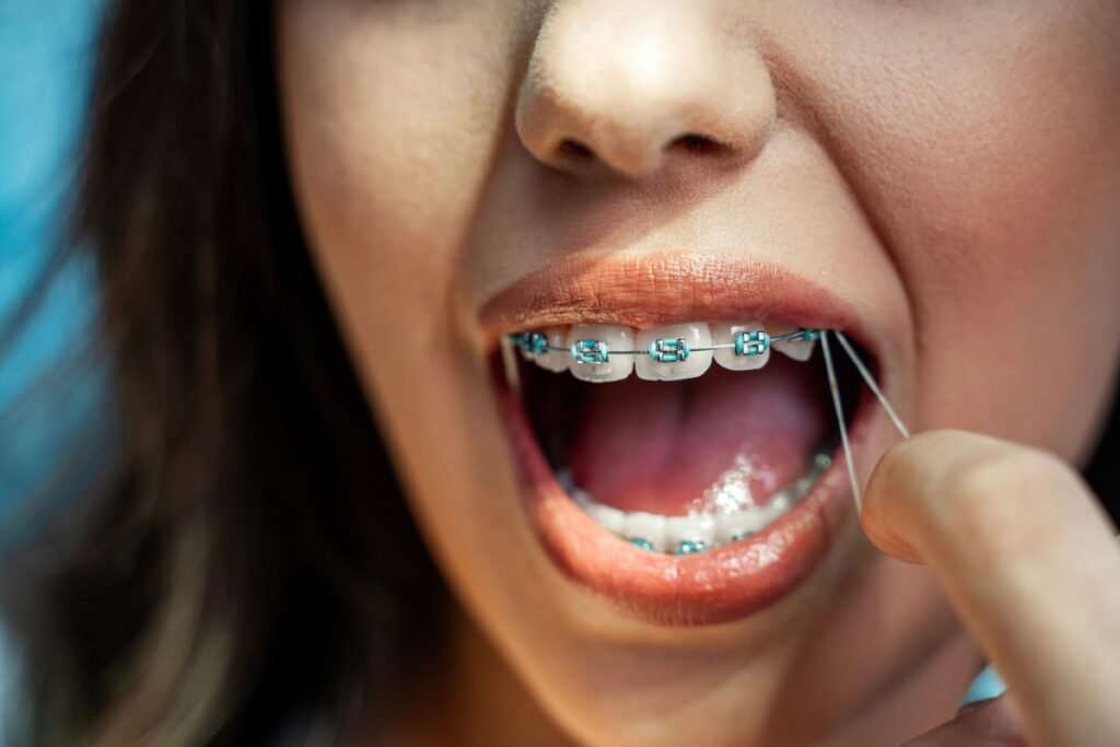 A woman wearing rubber bands on her braces